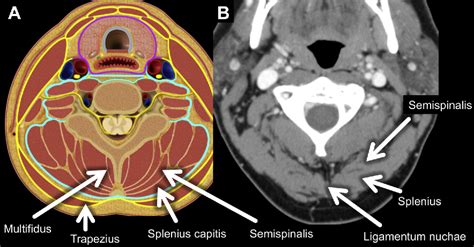 Perivertebral space 